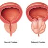 prostate-gland-enlargement
