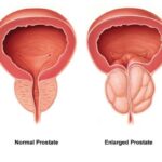 prostate-gland-enlargement