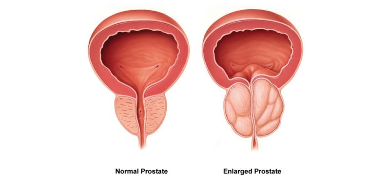 prostate-gland-enlargement