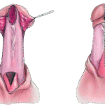 Urethroplasty-Surgery-in-Faridabad