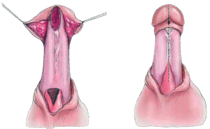 Urethroplasty-Surgery-in-Faridabad