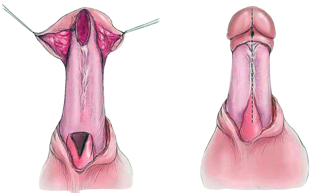 Urethroplasty-Surgery-in-Faridabad
