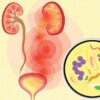 UTI infection