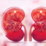 Kidney transplant