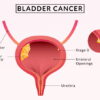 Bladder-Cancer-Doctor-in-Faridabad