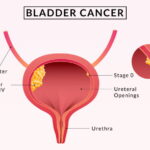 Bladder-Cancer-Doctor-in-Faridabad