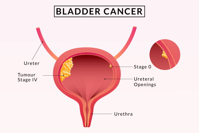 Bladder-Cancer-Doctor-in-Faridabad