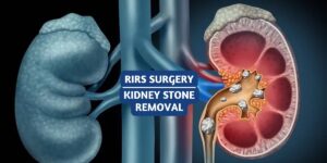 Recover Faster from Kidney Stones