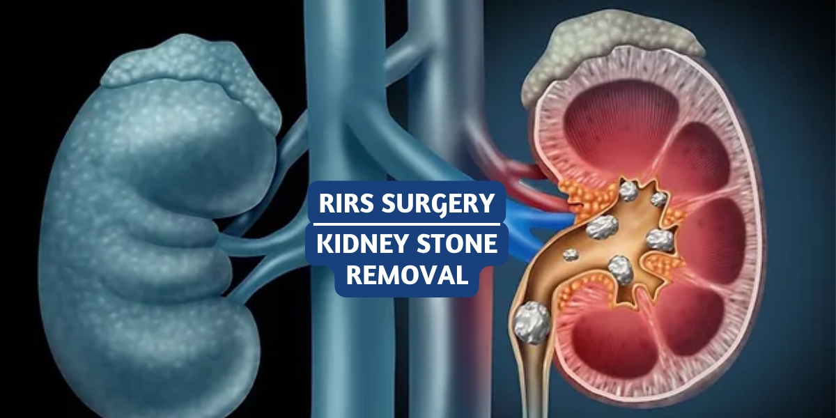 Recover Faster from Kidney Stones